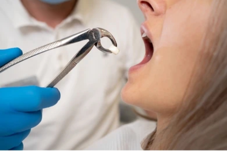 Tooth Extractions-------20